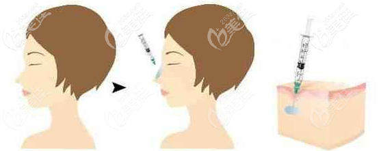 玻尿酸隆鼻和注射植骨隆鼻 玻尿酸隆鼻和注射植骨隆鼻