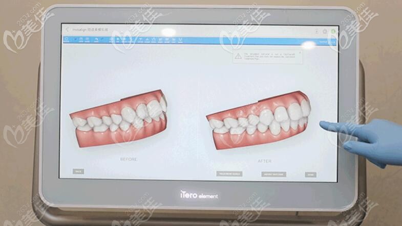 口扫设备上模拟的牙齿移动图