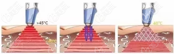 btl射频原理示意图 btl射频原理示意图