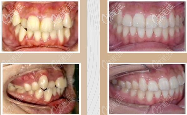 北京诺美口腔虎牙拥挤排列不齐矫正前后照片