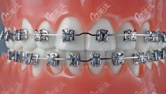 金属托槽矫正