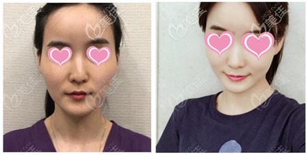 黄金微雕加脂肪填充效果 黄金微雕加脂肪填充效果