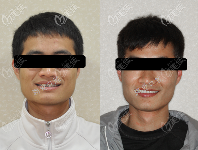 广州博爱牙科多生牙矫正案例