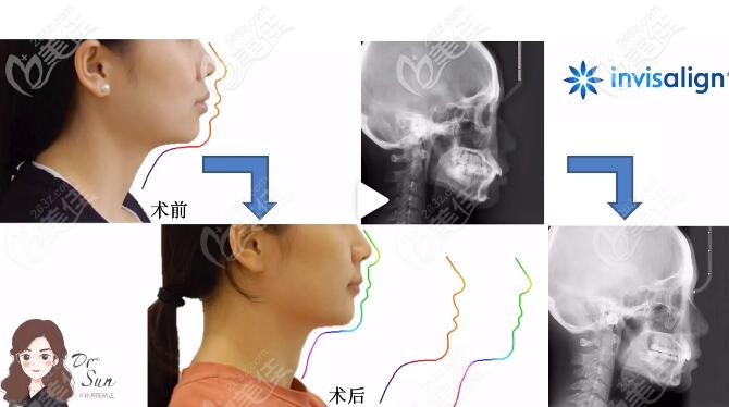 大连马泷齿科孙丹阳正畸案例
