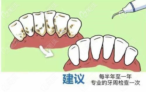 定期进行牙周检查预防