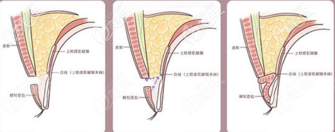 宁波壹加壹林勇双眼皮优势