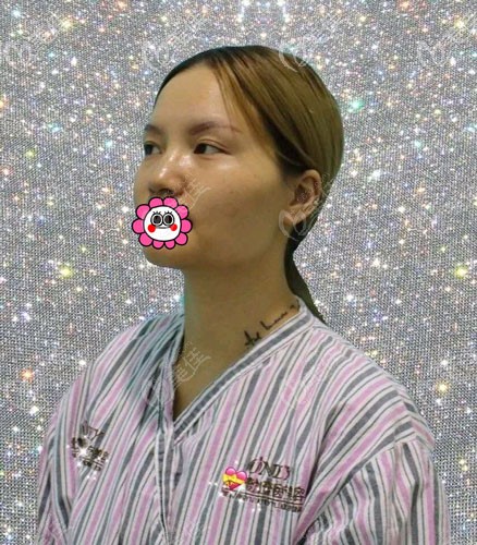 到宁波壹加壹做隆鼻前 到宁波壹加壹做隆鼻前