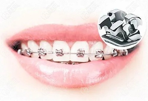 单颗烤瓷牙不影响牙齿矫正