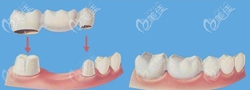 连桥牙冠影响牙齿矫正