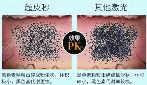 超皮秒激光祛斑和普通激光祛斑的差别 超皮秒激光祛斑和普通激光祛斑的差别