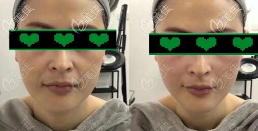 脸部3d立体网格提升案例效果对比图 脸部3d立体网格提升案例效果对比图