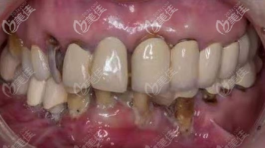 失败的烤瓷牙 失败的烤瓷牙