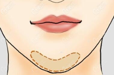 垫下巴改善下巴短小