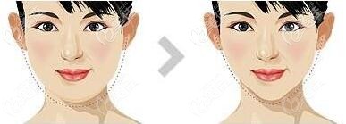 面部吸脂改善婴儿肥拥有小v脸