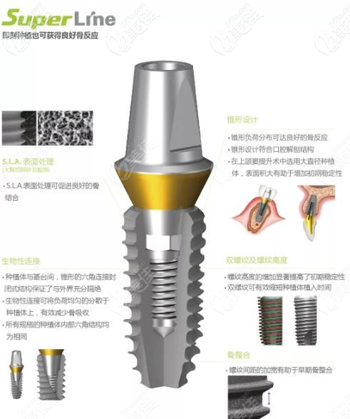 韩国登腾种植体
