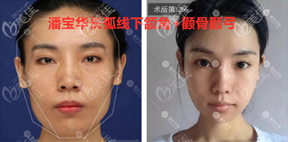 重庆华美潘宝华长曲线下颌角+颧骨颧弓图 重庆华美潘宝华长曲线下颌角+颧骨颧弓图