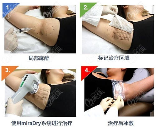 miradry微波治疗腋臭的过程