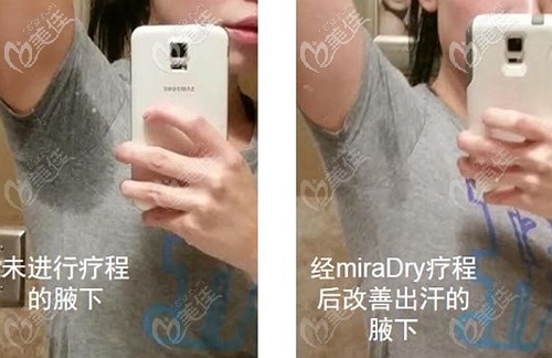 miradry微波治疗腋臭的疗效