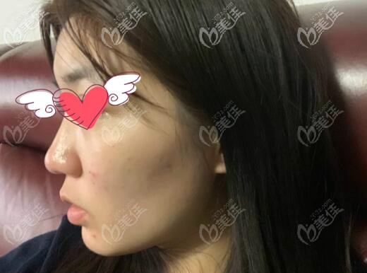 我骨性凸嘴戴牙套正畸2年后没用,花十万做正颌手术才恢复正常面型!