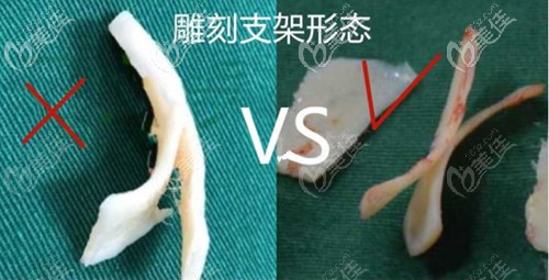 <!--<i data=20240703-sp></i>-->做肋骨鼻的优势 <!--<i data=20240703-sp></i>-->做肋骨鼻的优势