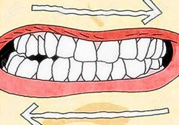 好奇矫正医生为啥总建议磨牙后移