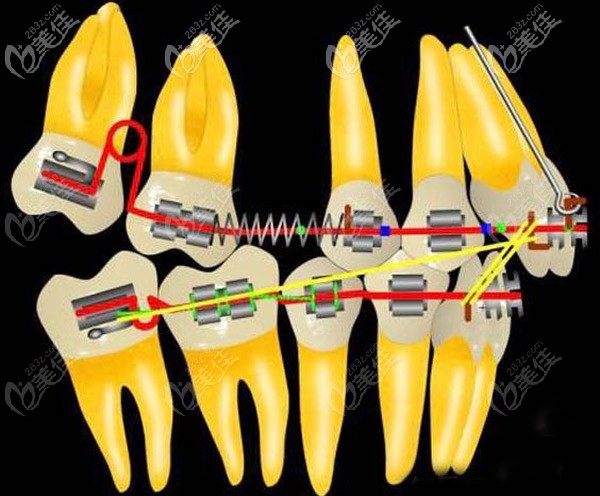 磨牙远移对脸型的影响（改善）大不