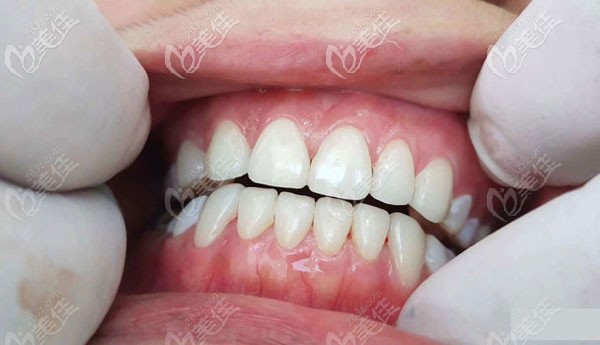 在毕节市矫正地包天牙齿+全瓷贴面美牙,我选的是七星关区的朗朗口腔