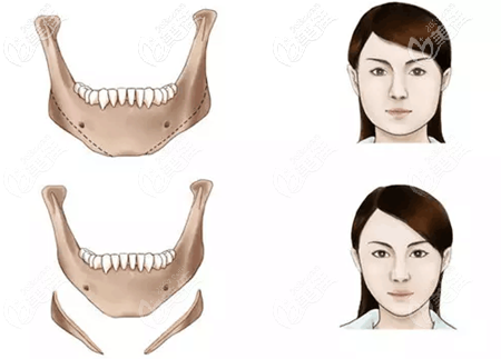 长曲线下颌角截骨手术效果对比