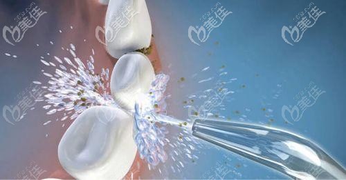 洗牙的四种类型