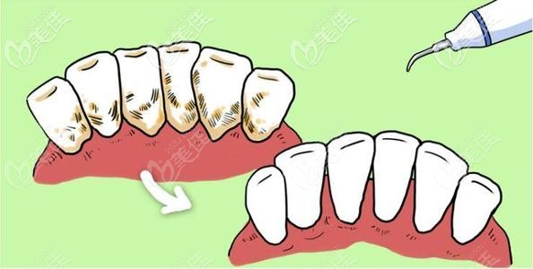 洗牙前后对比照