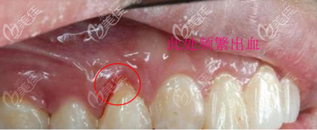 牙齿种植后频繁出血