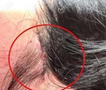 小切口面部提升的优势 小切口面部提升的优势