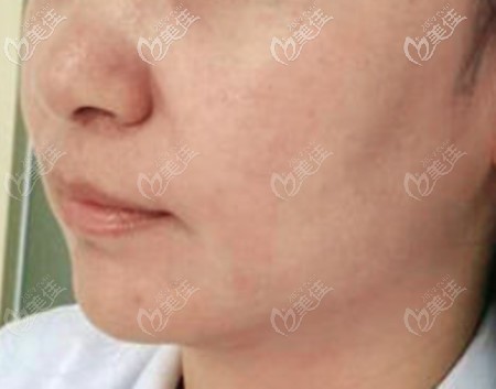 小切口拉皮手术3年以后的效果 小切口拉皮手术3年以后的效果