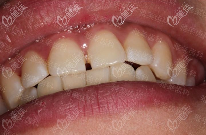 做隐适美矫正前