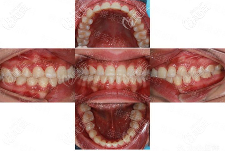 杭州雅莱隐适美矫正后