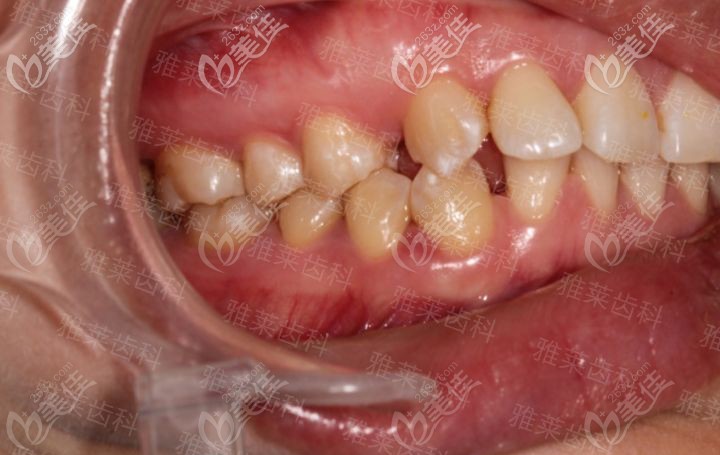 杭州雅莱纪亚梅时代天使矫正前