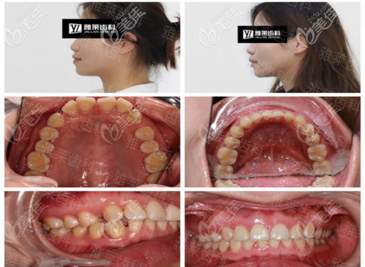 纪亚梅时代天使隐形矫正案例