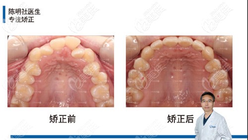 牙弓狭隘也有了明显的扩弓