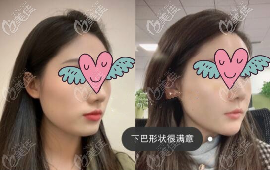 下颌缘凹陷填充脂肪30天变化对比照片
