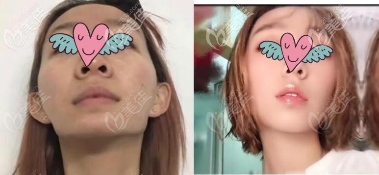 下颌角切多了填充人工骨修复一年效果对比图