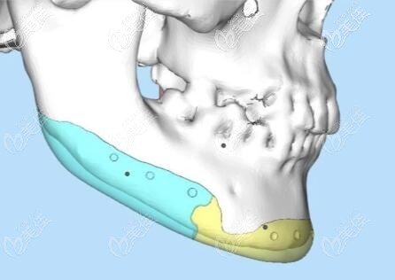 人工骨补下颌角安全性介绍