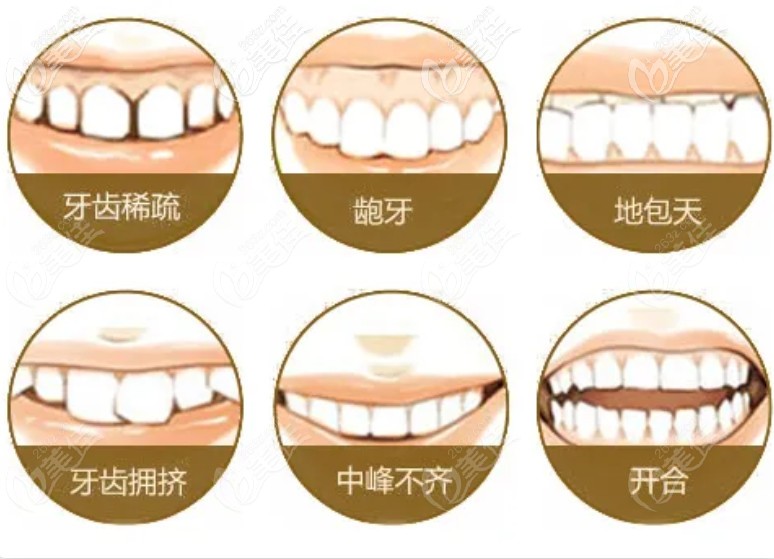 牙齿不齐的类型