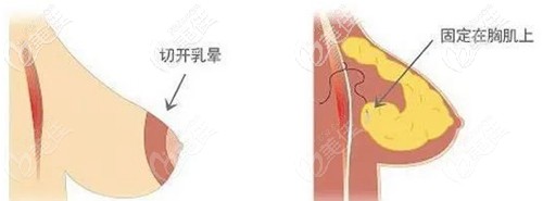 胸部乳房悬吊线断了