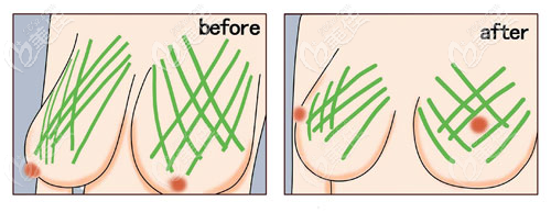 乳房悬吊手术方法