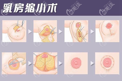乳晕切口乳房缩小手术方法