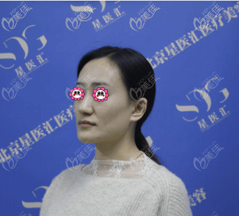 北京如朵医疗美容门诊部孔彦霞术前照片1