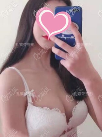 假体隆胸术后恢复3个月