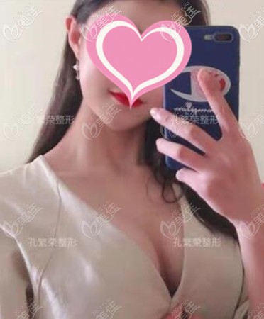 内窥镜隆胸术后真实感触:放的曼托250cc手术没想象中的疼