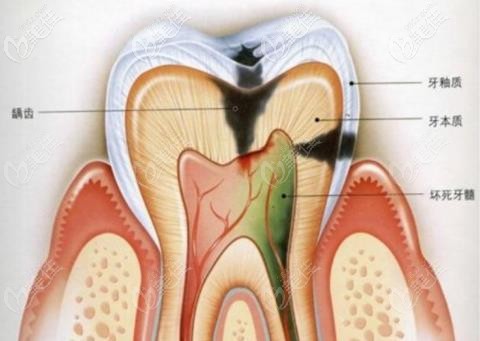 初期尽量保留活髓 初期尽量保留活髓