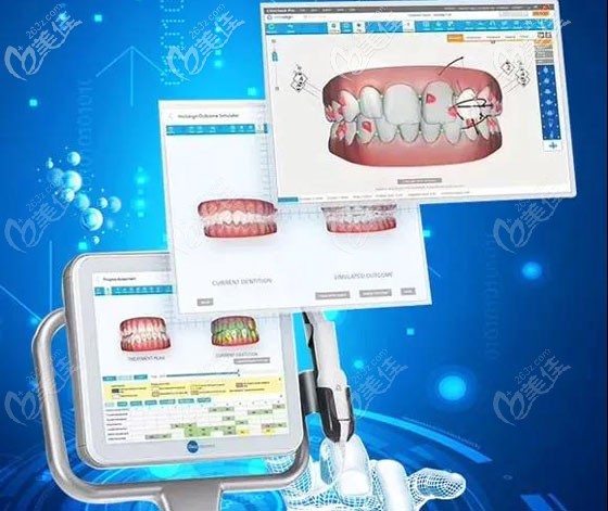 隐适美iTero口扫的扫描流程